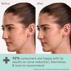 Lotus Cosmetics Derma Botanics Kojic Acid + Multi Berry Blemish Free Facewash 100g