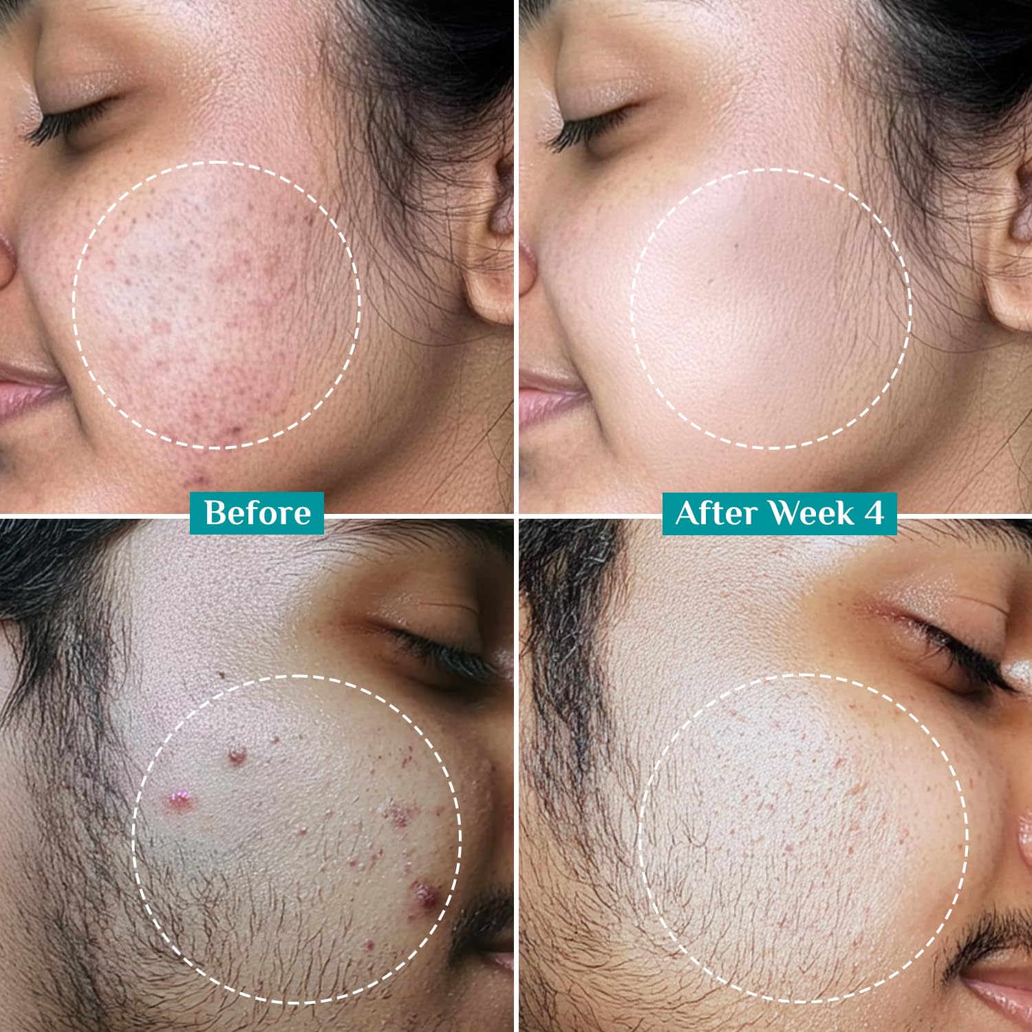 Pilgrim Cosmetics 2% Salicylic Acid Anti-Acne Face Serum 30ml