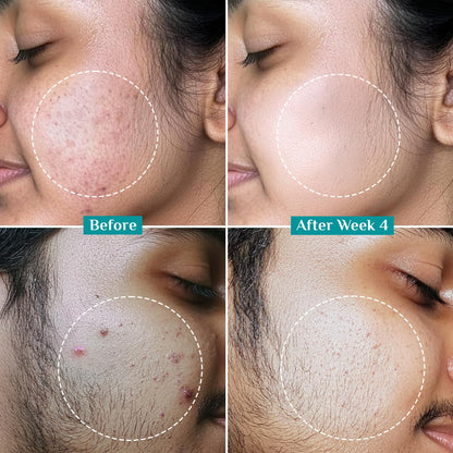 Pilgrim Cosmetics 2% Salicylic Acid Anti-Acne Face Serum 30ml