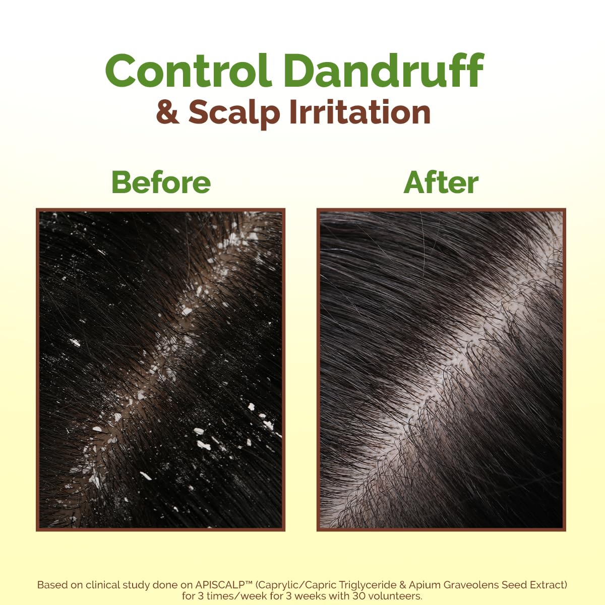 Mamaearth Lemon Anti-Dandruff Hair Oil with Lemon & Ginger 100ml