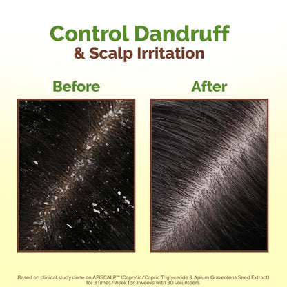 Mamaearth Lemon Anti-Dandruff Hair Oil with Lemon & Ginger 100ml