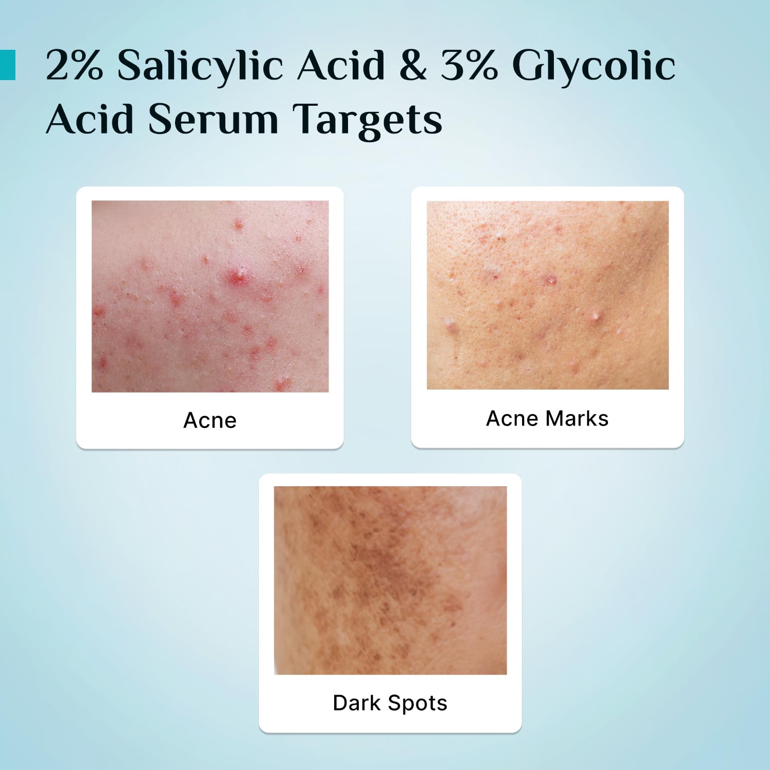 Pilgrim Cosmetics 2% Salicylic Acid Anti-Acne Face Serum 30ml